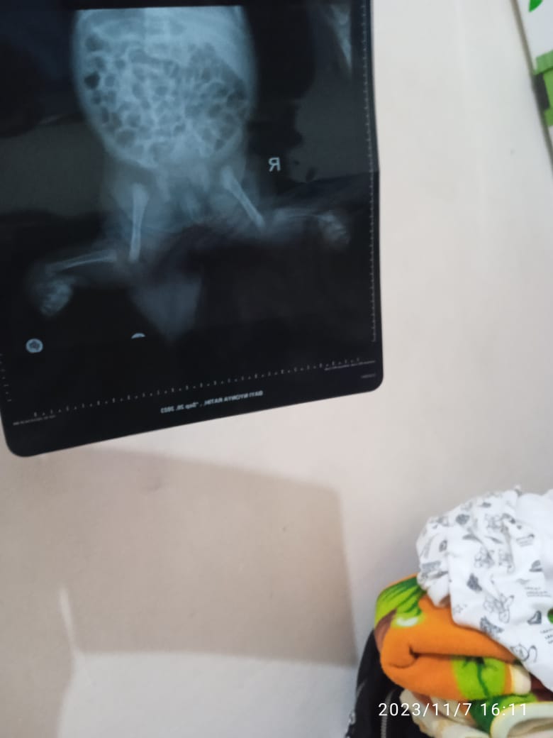 makeitups's tweet photo. “Do Your Magic!”

Kasian banget De Zahra. Ia ngalamin CTEV, penyakit langka yang bikin kakinya pengkor. Ayah sama ibunya cuman mengandalkan perban gips buat nyegah biar bengkok di kaki anaknya nggak makin melebar. https://t.co/KvH1bvuJQS