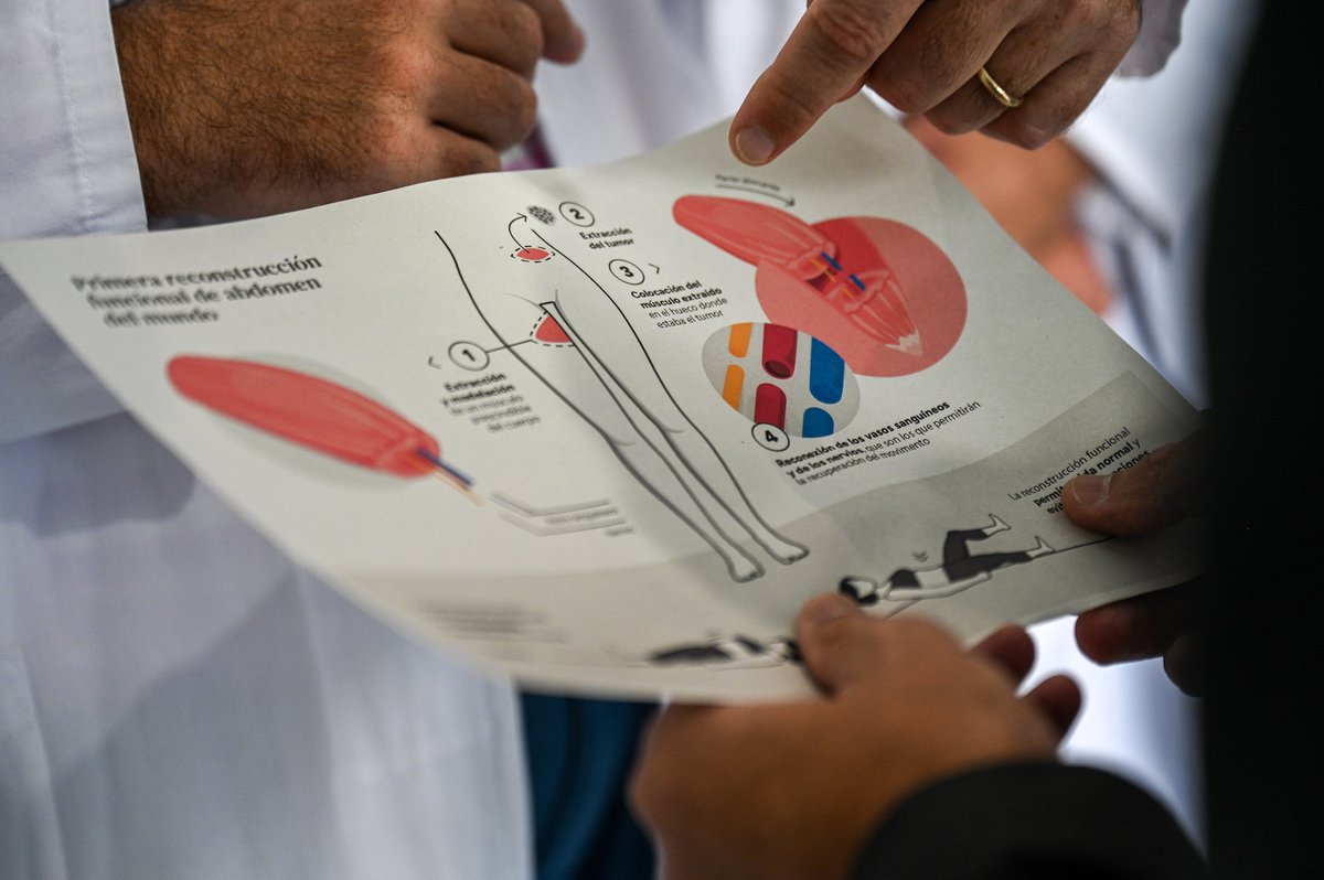 🔵 El conseller <a href="/manelbalcells/">Manel Balcells</a> ha presentat avui a <a href="/HospitalSantPau/">Sant Pau - Campus Salut Barcelona</a> la primera reconstrucció d’abdomen que recupera totalment la seva funcionalitat, una operació quirúrgica pionera al món que posiciona al Sant Pau com un hospital pioner a escala global.