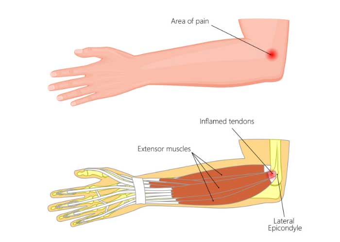 Onset of #tenniselbow symptoms typically happens gradually over the course of weeks or months. Symptoms include: · Pain at the outer elbow · Weakened strength while gripping · Weakness of wrist & hand extension · Burning sensation on lateral of the elbow medilink.us/3gqu