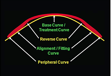 CLS_magazine's tweet photo. In his column this month, Anith Pillai, OD, discusses the architecture of an #orthokeratology retainer to properly achieve a successful fitting result. https://t.co/1mKyMHRGK6 https://t.co/DQUTRL3g2N