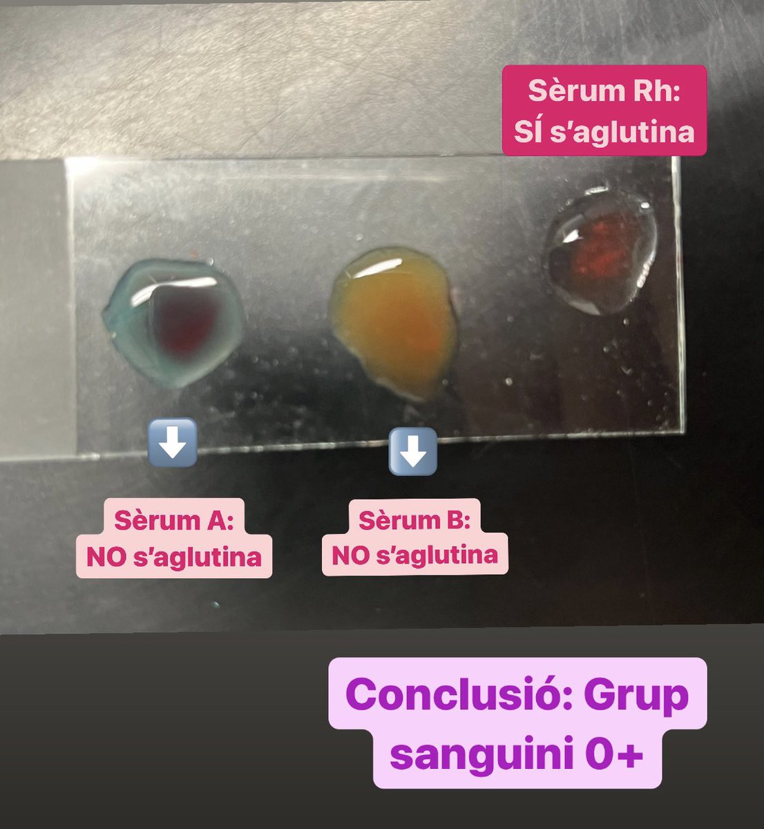 normaabella_'s tweet photo. A @BojosLa hem après a determinar el nostre #GrupSanguini a partir de la nostra #sang barrejada amb diferents sèrums (anti-A, anti-B i anti-D). El meu resultat és 0+, el grup sanguini més comú. #JEStGervasi https://t.co/2957SUCfAE