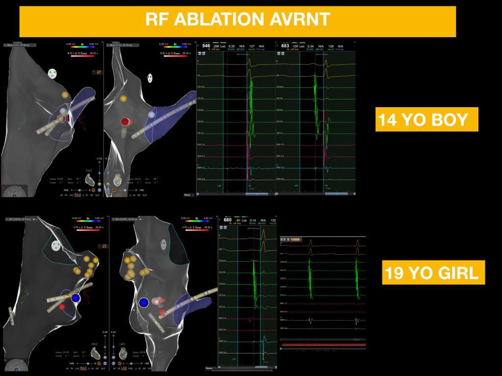 Two RF #carto cardiac ablations of AVNRT in two teenagers. 19 yo girl with transient parasympathetic hypertone and junctional rhythm (90 RF) in basal. 14 yo boy with palpitations during sport 
Done ! 
#epeeps
#arrhythmias
#pediatriccardiology
Thanks to all! taormina