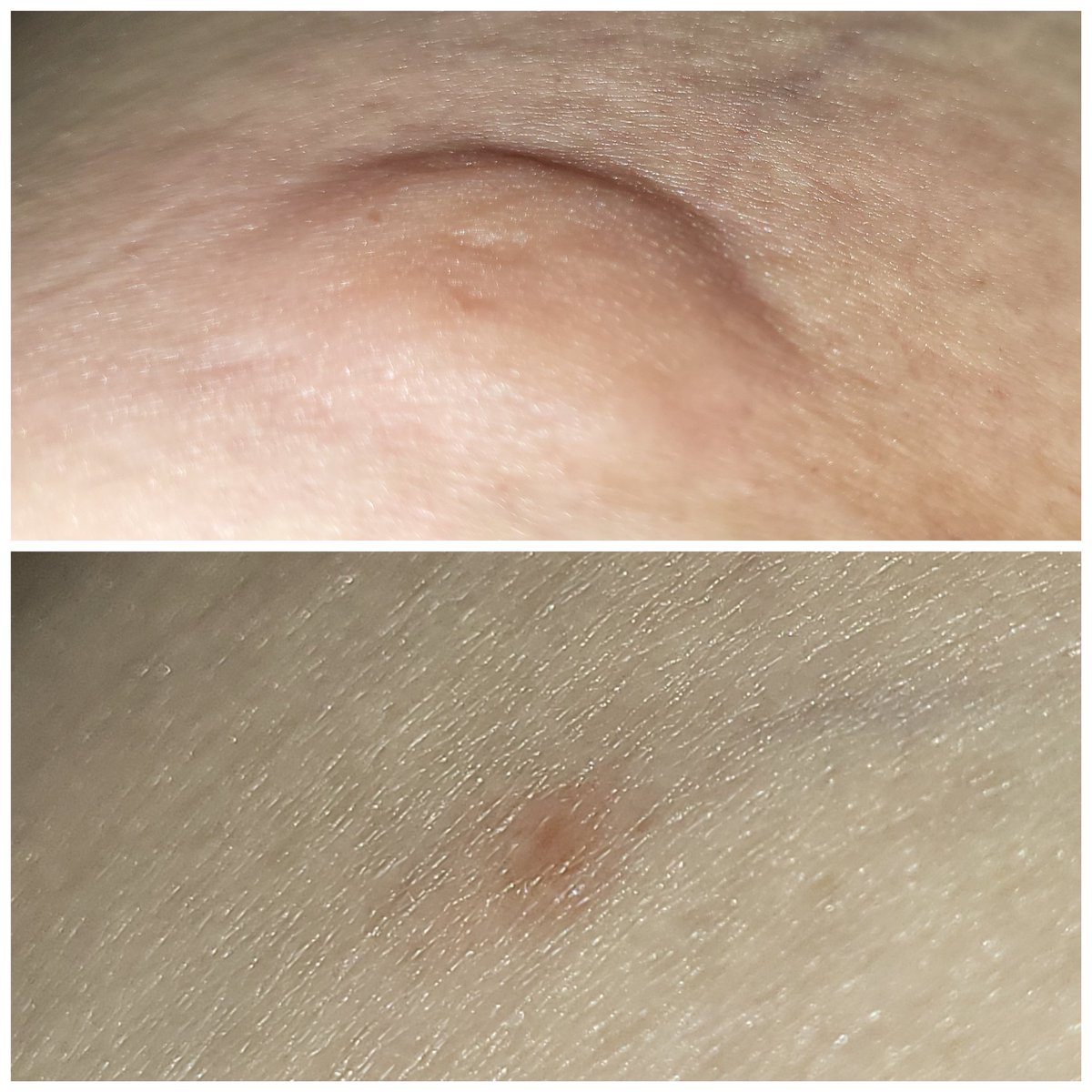 OzarksFuture's tweet photo. I woke up to a random unknown spider bite. One drop of immune align and one dose of pain be gone,  12 hours later... like it never happened. 
Real medicine https://t.co/G19Fo0QLaC https://t.co/iZegSziMlO
