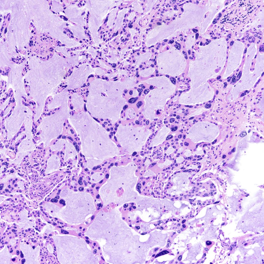 Striking mucinous pattern with giant cells in this metastatic lung adenocarcinoma. #pathology #neuropath #pathtwitter