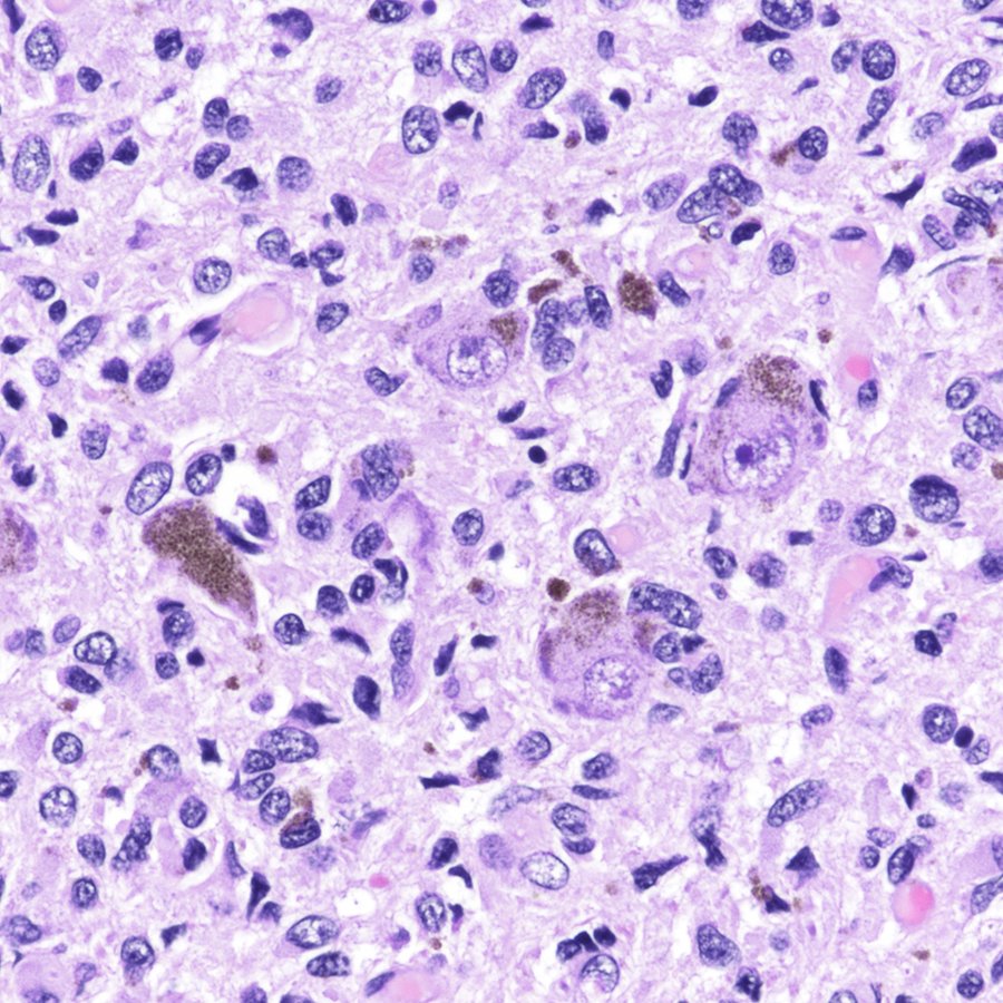 Substantia nigra (midbrain) and locus coeruleus (pons) neurons overrun by #glioblastoma that started way up in the frontal-parietal lobe. Poor neurons must be wondering what happened, it used to be such a nice neighborhood... #pathology #neuropath #pathtwitter