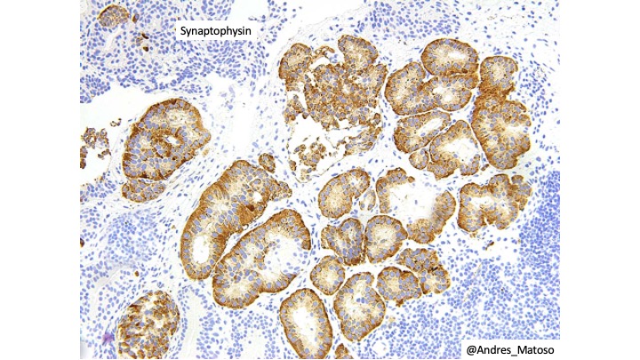 Bladder carcinoids are usually small and have a tubular/glandular architecture that could mimic adenocarcinoma. The overlying urothelium with cystitis cystica glandularis/hyperplasia is characteristic. #GUpath