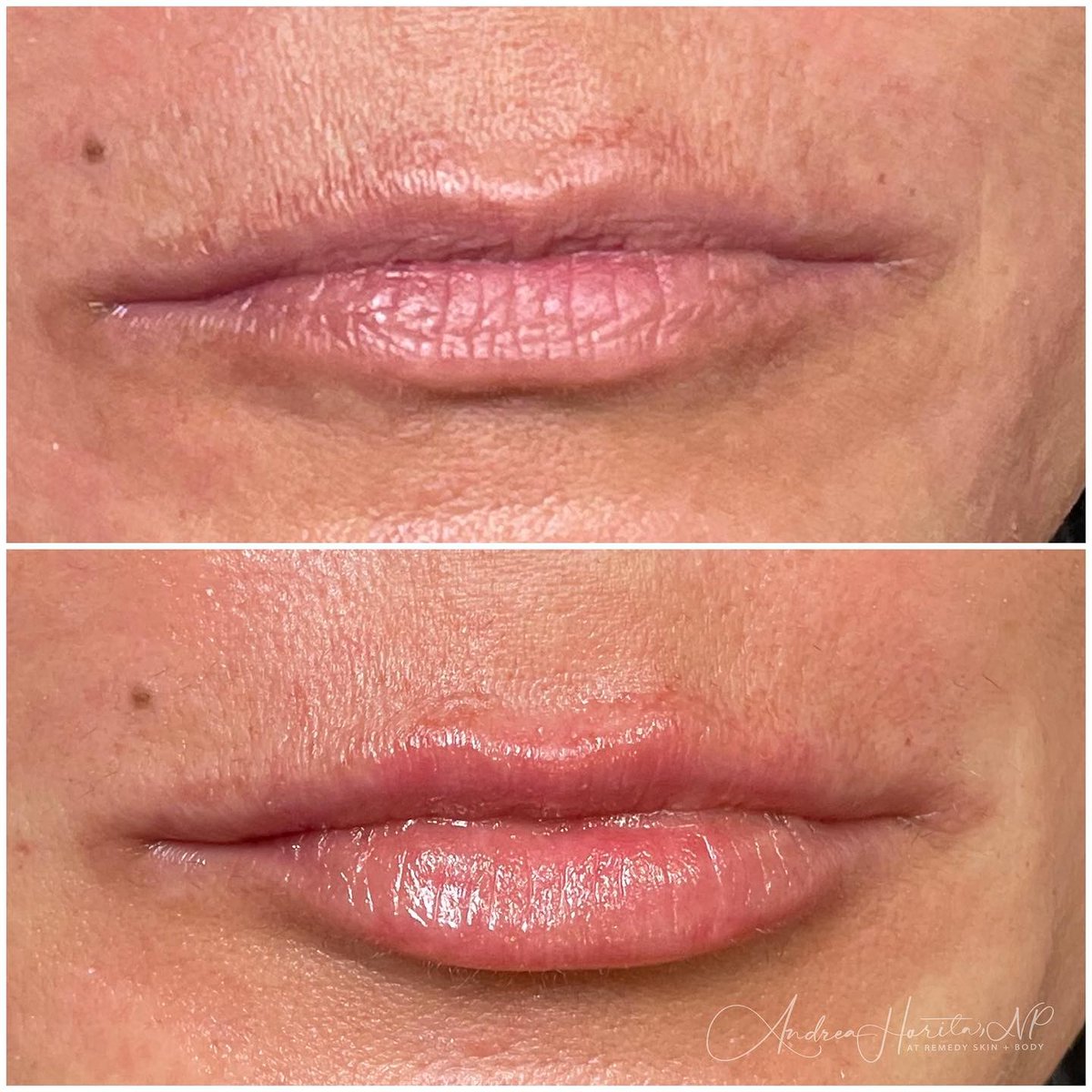 Remedyskinbody's tweet photo. Our patient desired to maintain her natural lip shape while addressing age-related changes. We used less than one syringe of #Refyne to achieve this. There may be slight swelling post-placement, she's on her way to enjoying beautifully hydrated and entirely natural-looking lips. https://t.co/i4KZtr5r5w