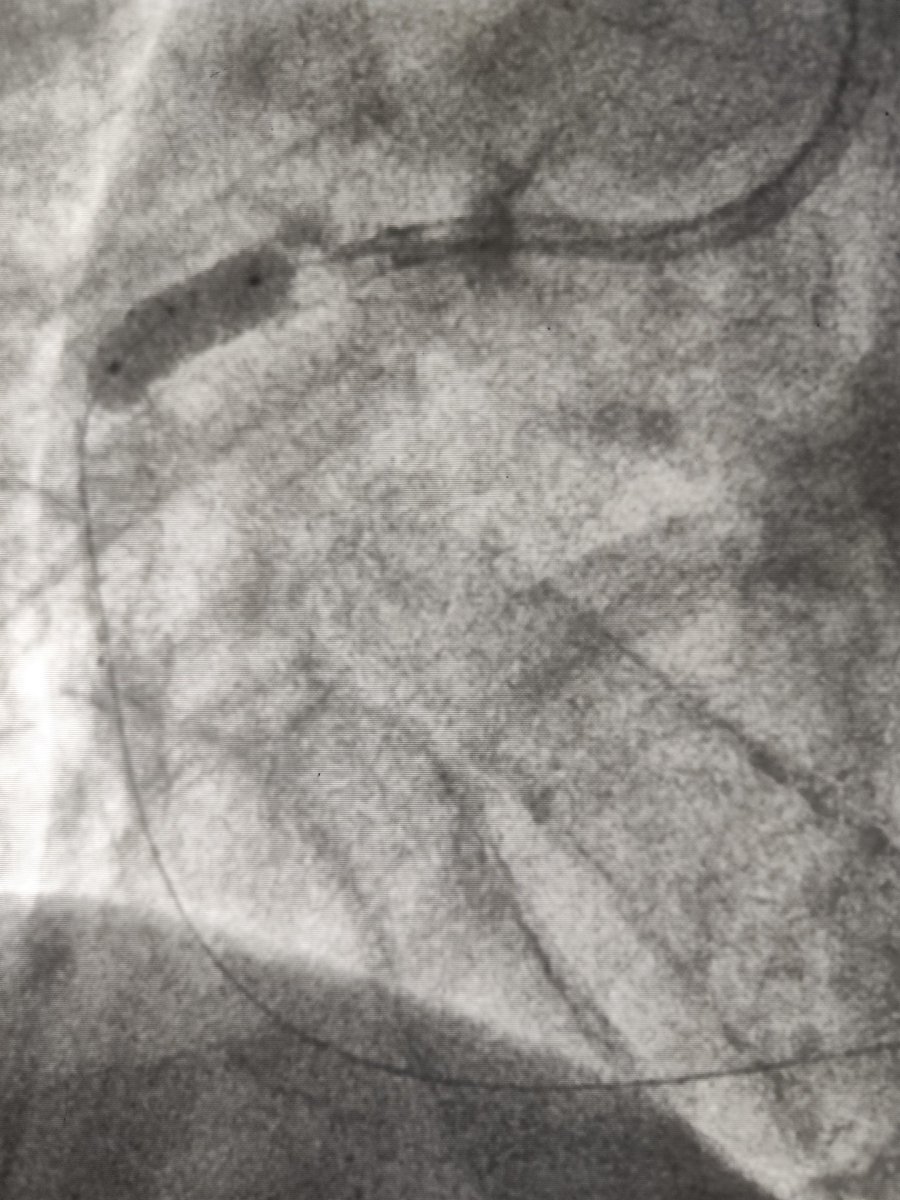 MarekRadomski71's tweet photo. #CardioTwitter #CHIPPCI #Ca #PCI male patient with 2 weeks of stenocardia and inferior STEMi evolution in ECG. Huge RCA full of calcium and thrombus. Long difficult PCI with 6 balloon for predilatation. Finally 2 stents 4,5mm postdilated with 5,0mmcNC balloon up to 22 atm https://t.co/npRuXCW3Za