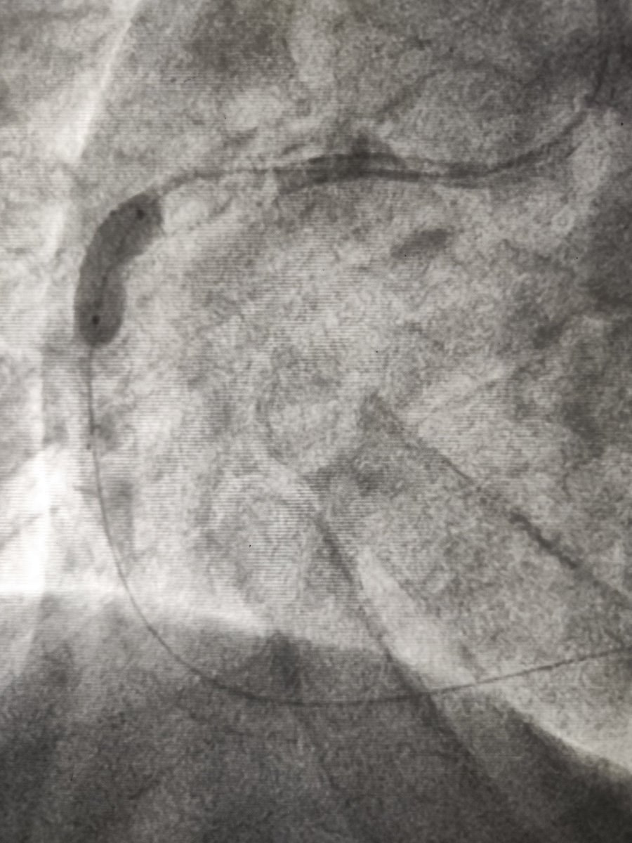 MarekRadomski71's tweet photo. #CardioTwitter #CHIPPCI #Ca #PCI male patient with 2 weeks of stenocardia and inferior STEMi evolution in ECG. Huge RCA full of calcium and thrombus. Long difficult PCI with 6 balloon for predilatation. Finally 2 stents 4,5mm postdilated with 5,0mmcNC balloon up to 22 atm https://t.co/npRuXCW3Za