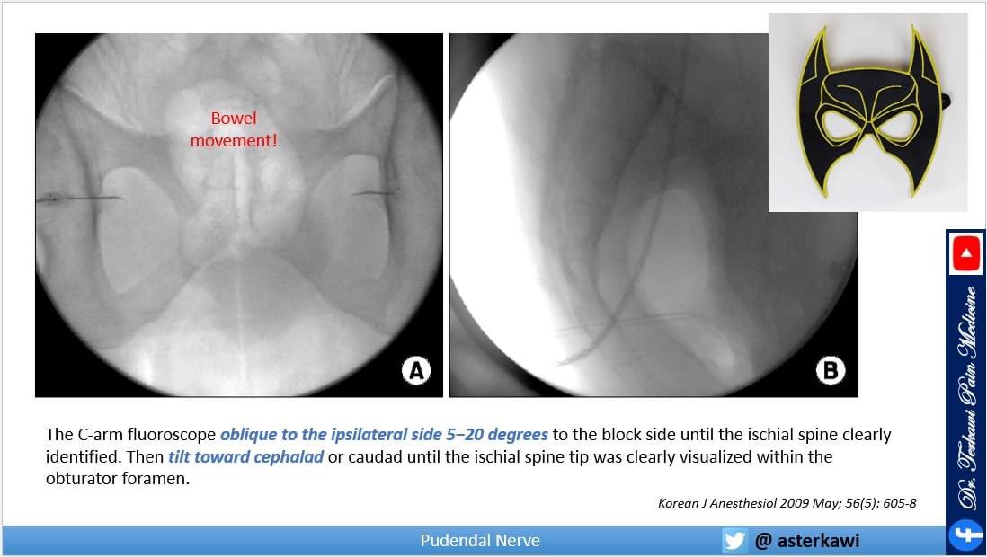 Whether you like fluro or ultrasound, watch this lecture to know them all: youtu.be/yAyZEOE4I2M

Learn and Enjoy!

#PudendalNerve #pelvicpain #GenitalPain #PudendalNeuralgia #PudendalBlock #PudendalAnatomy