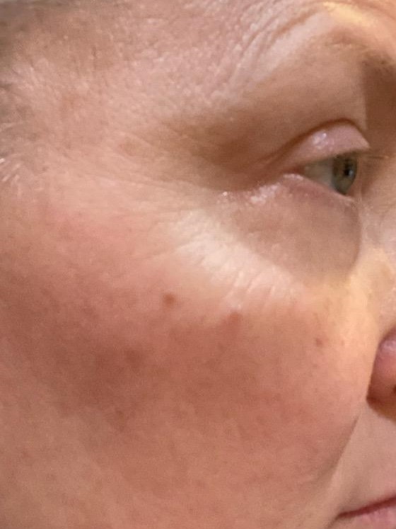 CastleHillsEC's tweet photo. Even Just 72 Hours Later the Results are Noticeable!
Skin is Notably Clearer and The Rosacea is Starting to Fade! IPL and RF can get your Skin Healthier, Clearer, Brighter and Fight Dry Eye Syndrome. 
#castlehillseyecare #ipl #dryeyesyndrome #skincare #rosacea #healthcare #beauty https://t.co/qTypm0m5SK