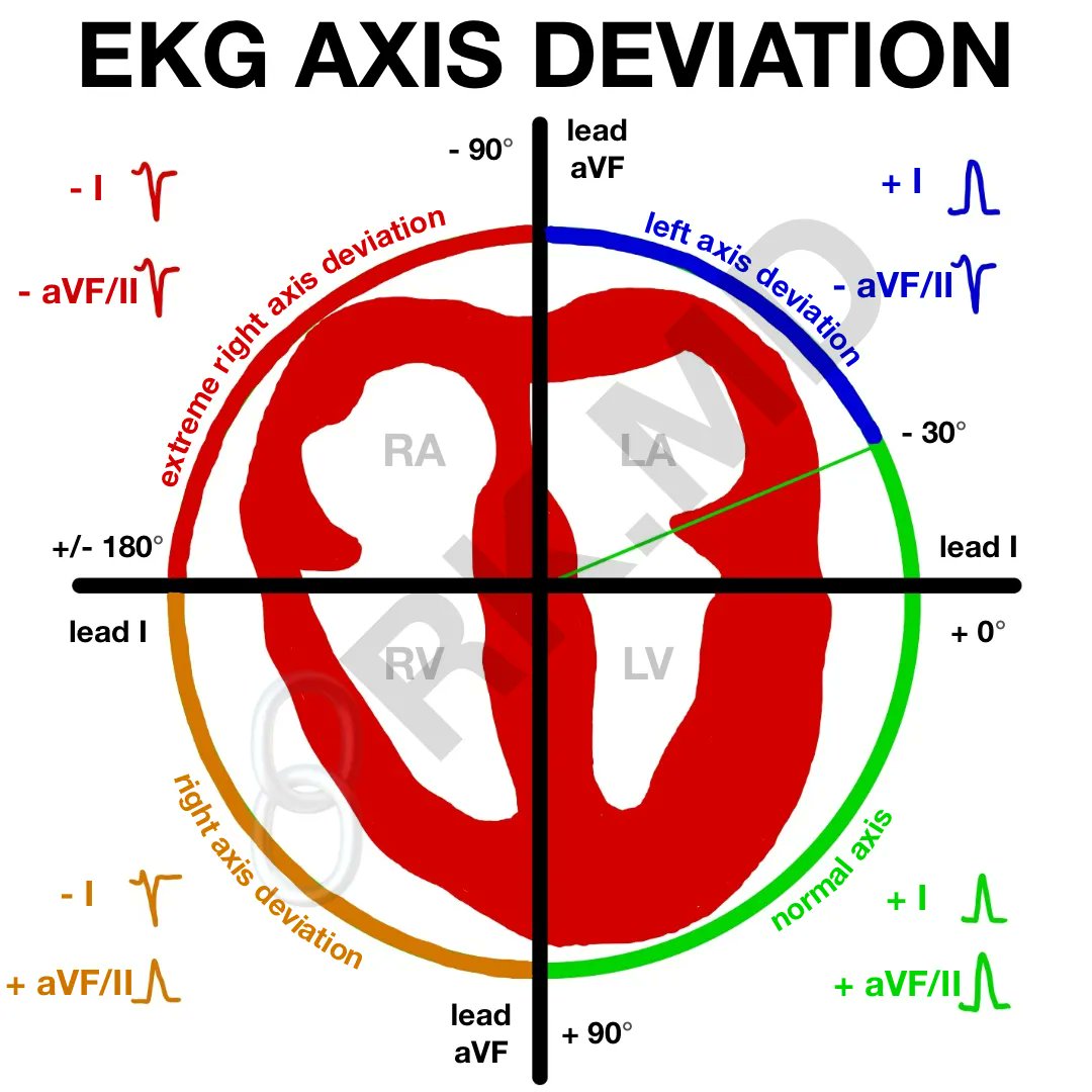 An overview of axis deviation on the blog: rk.md/2017/ekg-axis-… #medtwitter #foamed