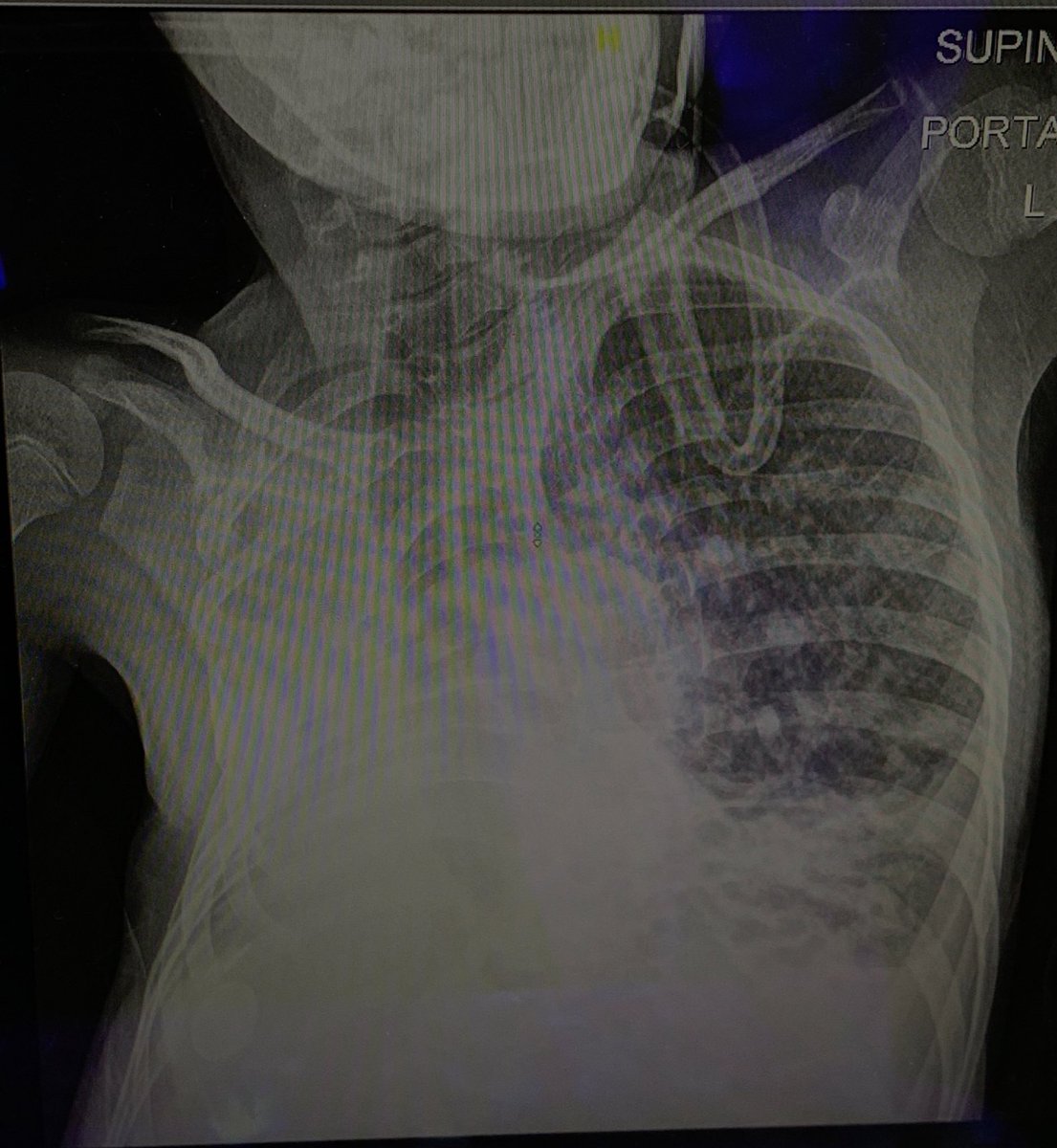 اسولف واضحك مع الطفل واعطيته بخار والأمور تمام ولكن، ماكنت اسمع صوت بالجهة اليمين بالسماعة فـ رحت اشوف X-ray 

يطلع ماعنده رئة باليمين😶