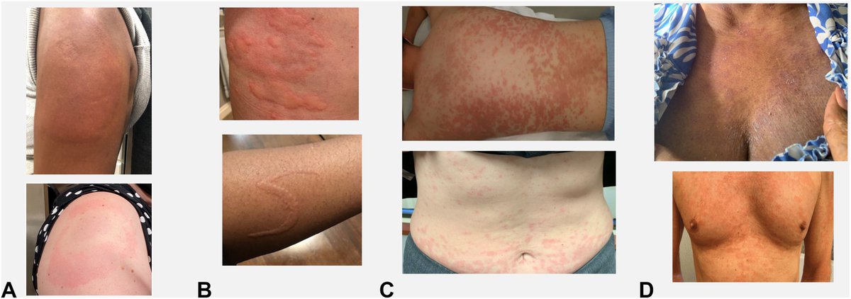 In Current Issue (FREE)! An Update in #COVID19 #Vaccine #Reactions in 2023: Progress and Understanding buff.ly/3Qnhkjt