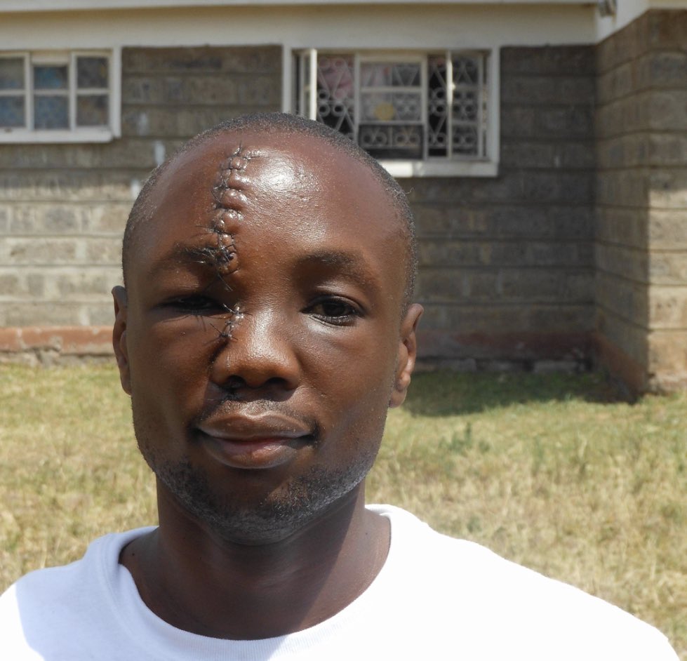 In 2012, a 24-year-old Kenyan man who worked at an orphanage called Anthony Omari woke up to find 3 machete-wielding thugs breaking in. 

He took on all three men at once and chased them outside, where the fight continued. But unfortunately, Anthony would take a machete to the