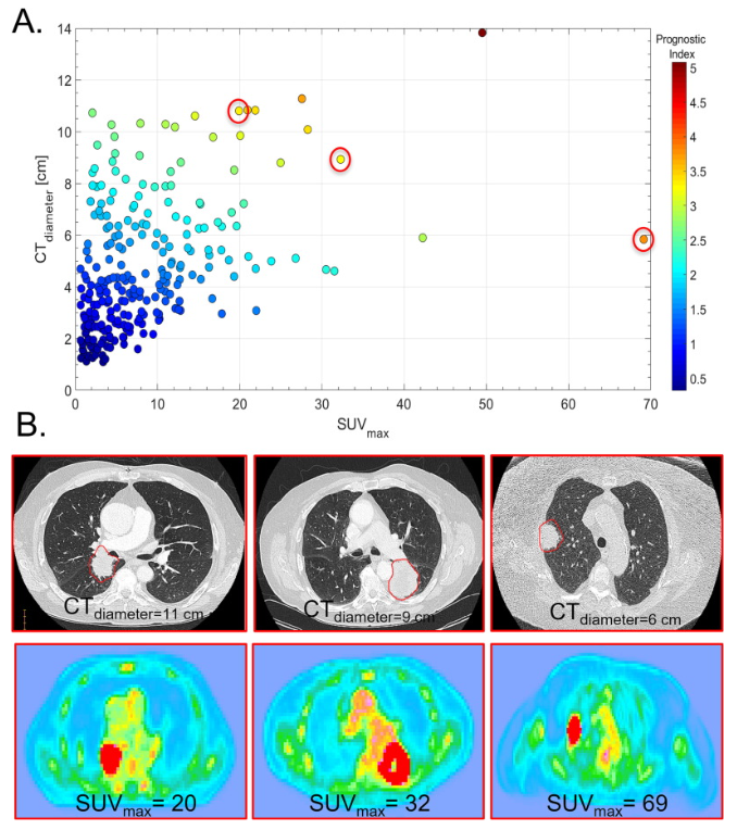 MSK_RadOnc's tweet photo. ☢️🫁⚡️Disease progression after definitive #radiation for early-stage #NSCLC #lungCancer occurs in 20-40% of patients. This study finds that pre-tx tumor diameter &amp; SUVmax successfully stratified pts at risk for progression after #SBRT for #lcsm.
➡️https://t.co/jo3eWQPQ0R https://t.co/1tfMCImwnw