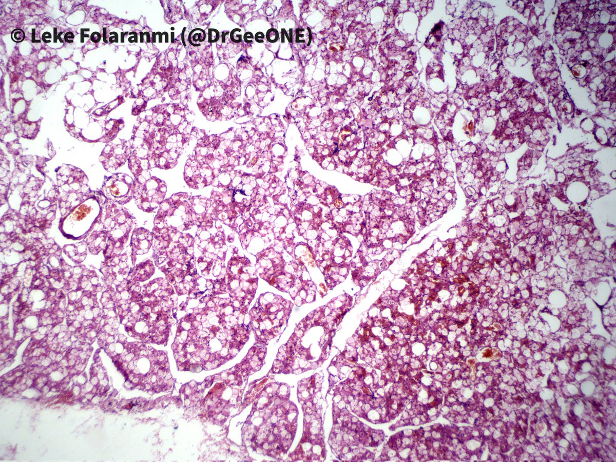 DrGeeONE's tweet photo. Celebrating #InternationalPathologyDay 2023 with this 'surprise' benign lesion we found in the breast tissue.
✳️ Hibernoma
#PathTwitter #BreastPath #PathX https://t.co/ib3apTxpvl