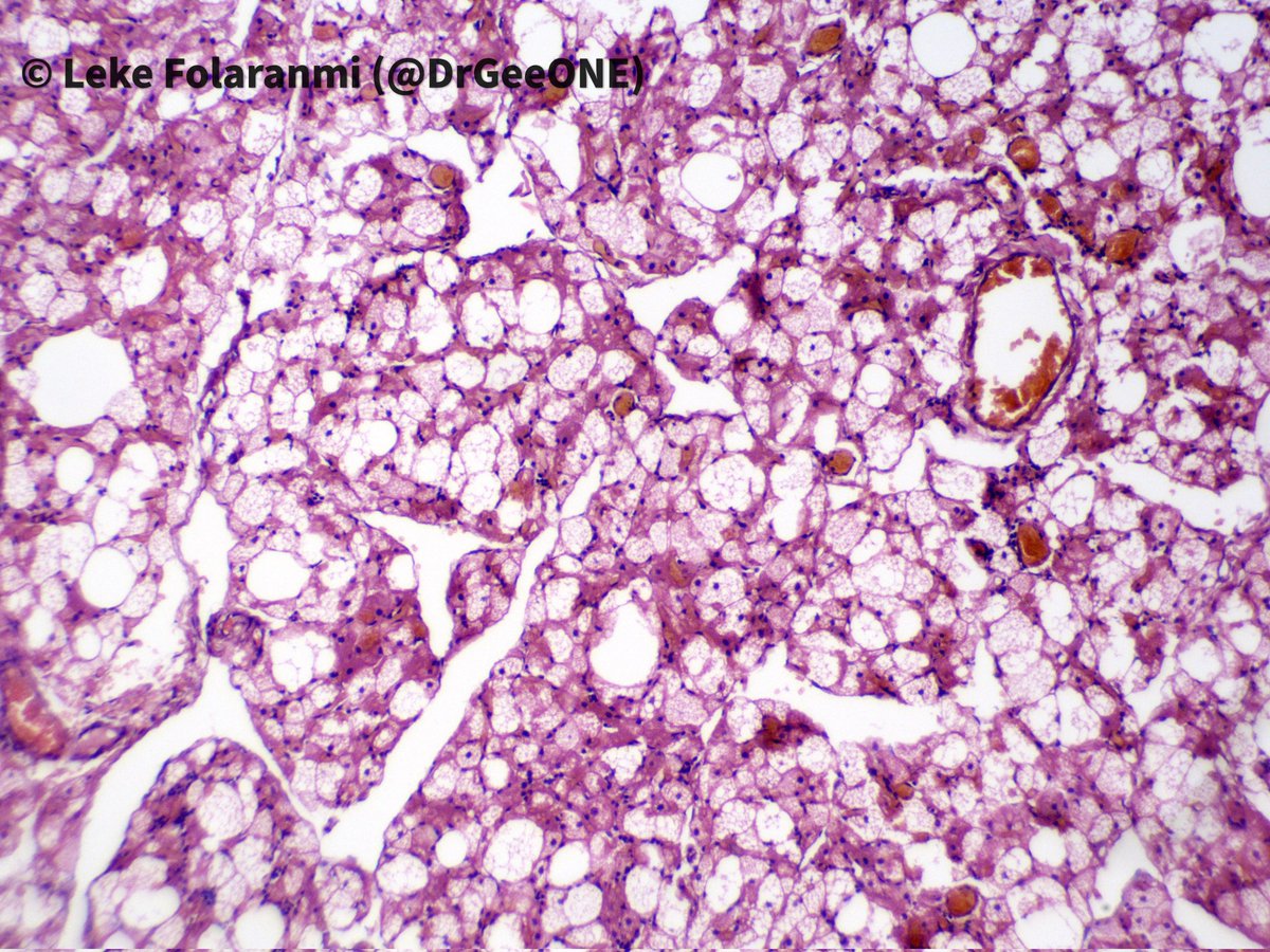 DrGeeONE's tweet photo. Celebrating #InternationalPathologyDay 2023 with this 'surprise' benign lesion we found in the breast tissue.
✳️ Hibernoma
#PathTwitter #BreastPath #PathX https://t.co/ib3apTxpvl