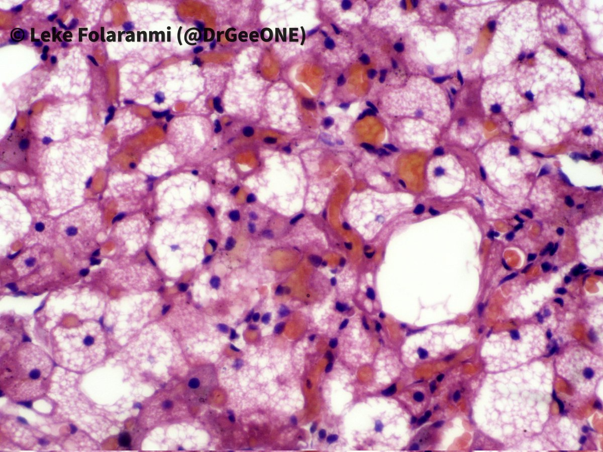 Celebrating #InternationalPathologyDay 2023 with this 'surprise' benign lesion we found in the breast tissue.
✳️ Hibernoma
#PathTwitter #BreastPath #PathX