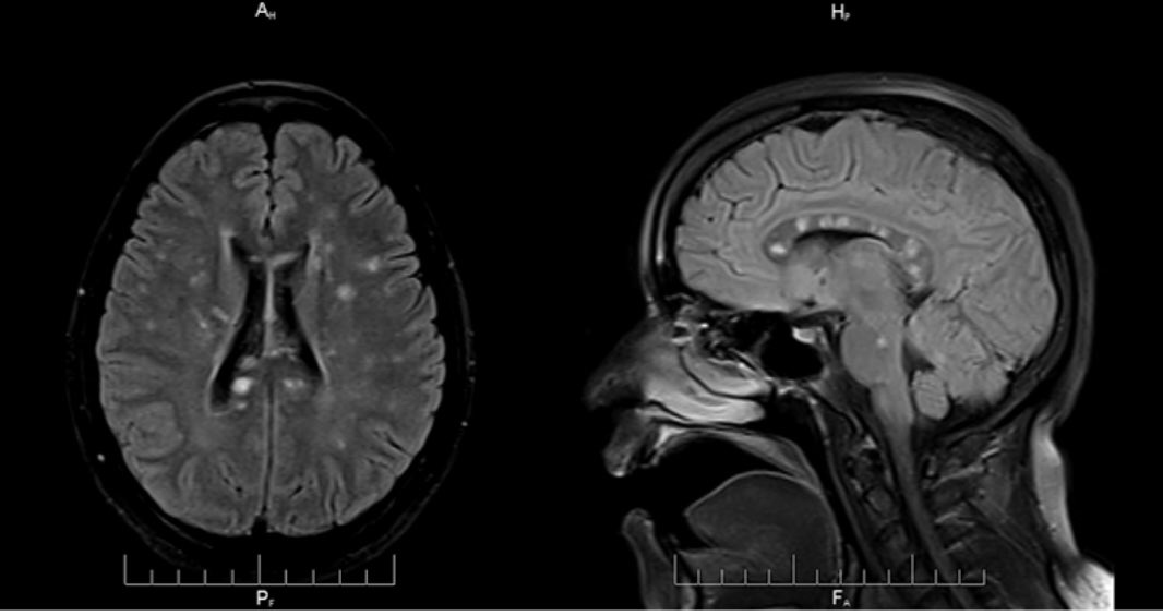 Neuro_Paz's tweet photo. 🩻 ¿De qué síndrome infrecuente es característico en RM el ❄️signo de las 𝗯𝗼𝗹𝗮𝘀 𝗱𝗲 𝗻𝗶𝗲𝘃𝗲 (𝘀𝗻𝗼𝘄𝗯𝗮𝗹𝗹 sign)❄️en 𝘤𝘶𝘦𝘳𝘱𝘰 𝘤𝘢𝘭𝘭𝘰𝘴𝘰? 🧠⬇️🤓 https://t.co/0Qbz3DqsyN