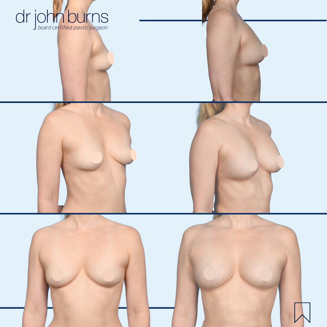 drjohnburns's tweet image. This patient sought to increase her breast volume without implants. With her naturally slender frame in mind, we harnessed the potential of #fattransfer. Dr. Burns harvested excess fat from various areas &amp;amp; re-injected to give upper pole fullness &amp;amp; define her cleavage.