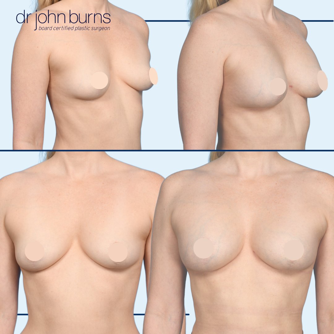 drjohnburns's tweet image. This patient sought to increase her breast volume without implants. With her naturally slender frame in mind, we harnessed the potential of #fattransfer. Dr. Burns harvested excess fat from various areas &amp;amp; re-injected to give upper pole fullness &amp;amp; define her cleavage.