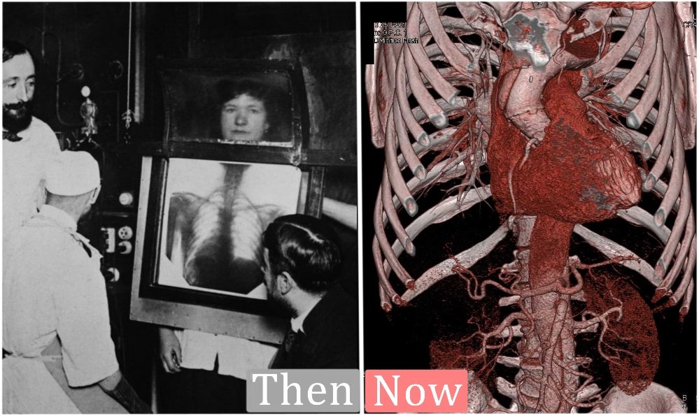 Happy International Day of Radiology, #IDoR! On this day, in 1895, Wilhelm Conrad Roentgen was the first to observe X-rays! 

Through modern advancements like digitalization and 3D reconstruction, it's just incredible how far our specialty has progressed!

#Radiology #Xray