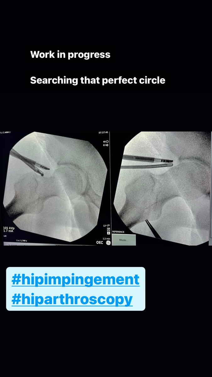 Searching the “perfect  circle”

#hiparthroscopy

#hipimpingement