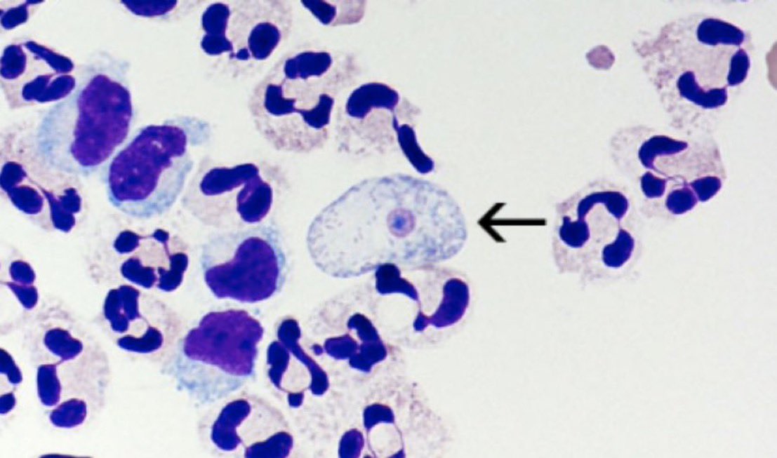 A 15yo boy swam in natural hot spring fresh water pool 2weeks ago &amp; now presents with headache, vomiting, fever, mental status changes x1d. Resp fail on vent. Ct head: diffuse edema. CSF shown. diagnosis? #medEd #idmedEd <a href="/IUIDfellowship/">Indiana University Infectious Diseases Fellowship</a>