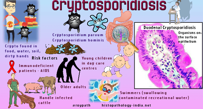 schowardjd's tweet photo. @BrownJHM @IUIDfellowship Cryptosporidiosis

(image credit: @DrSampyRoy, #roypath, https://t.co/wSxsr8fyZ8) https://t.co/1iikl1h22H