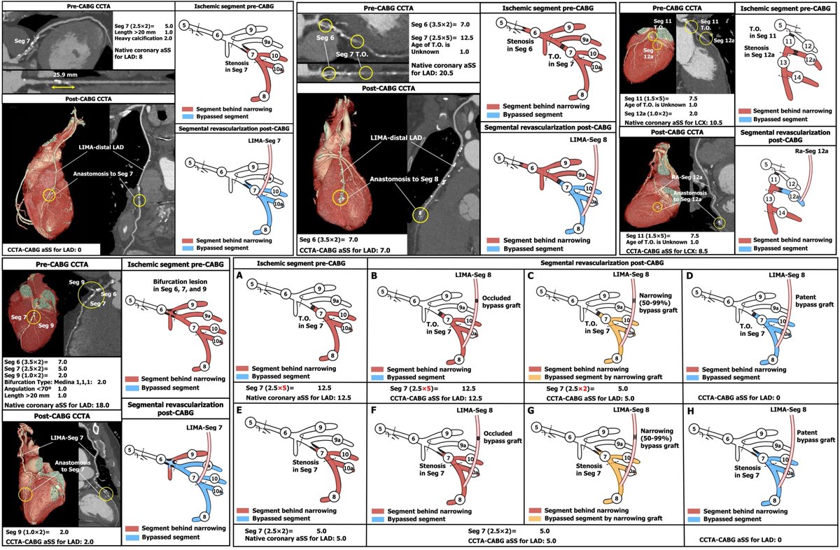 A NEW method by “the father of #SYNTAX”: #CCTA-based #CABG SYNTAX Score: a tool to evaluate completeness of coronary segment revascularization after bypass surgery Kotoku, #Serruys, Kageyama, de Mey, Andreini, Onuma et al. 👉link.springer.com/article/10.100… Int J Cardiovasc Imaging 2023