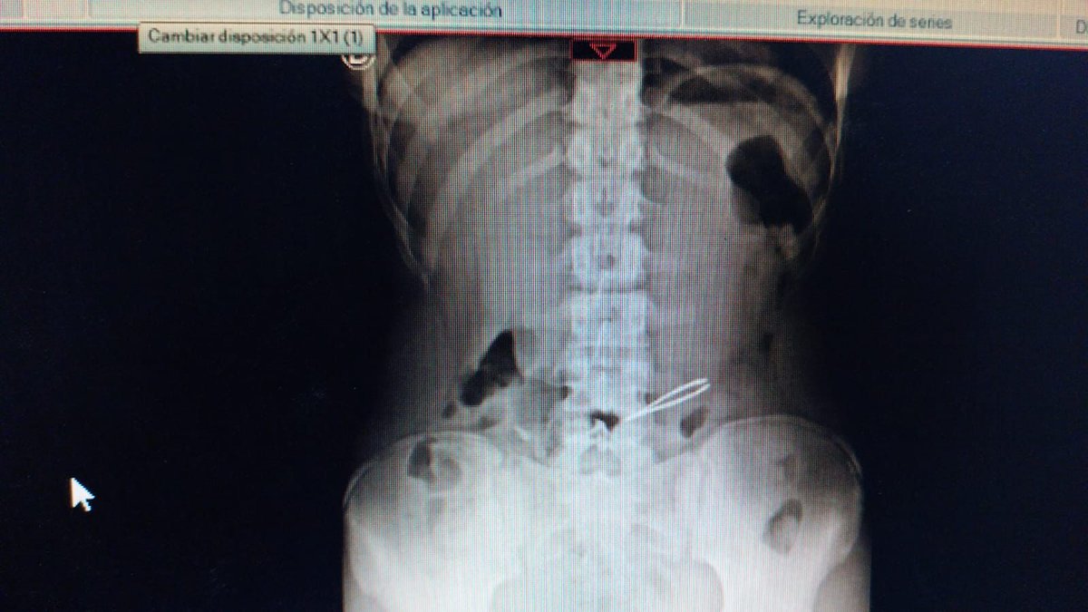 mi amiga se trago una pincita de depilar mientras le depilaba las cejas con otra, no pregunten como porque todavía no entendimos.
<a href="/aagospella/">aagospella</a>