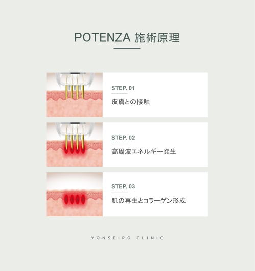yonseiroclinic's tweet photo. 話題のポテンツア!
韓国YONSEIRO CLINICにて『ポテンツア』キャンペーン♡

ポテンツアって❓
マイクロニードル×高周波RF×薬剤導入で毛穴、ニキビ跡、赤み、こじわと弛みを改善する美肌施術

★こんな方にお勧め★
☞ニキビ跡、広い毛穴とキメの改善を解決したい

#ポテンツア #毛穴 #ニキビ跡 https://t.co/FPNvi4Gepw