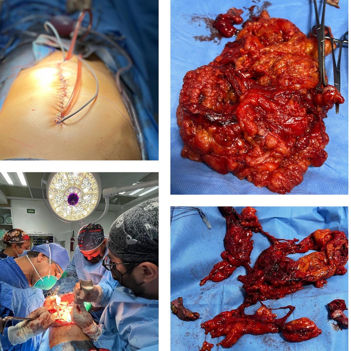 rdgzgarciaonco's tweet photo. 15 th Complete cytoreductive surgery plus HIPEC ⁦@SAOlatam⁩ ⁦@cuellarluis⁩ ⁦@Surgicalberserk⁩ ⁦@infantesoyer⁩ #peritonealsurfacemalignancies https://t.co/AFk2GN9IqG