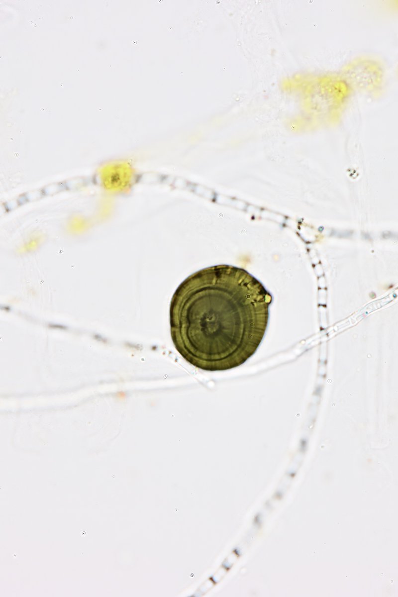 Leucine crystal amid fungal pseudohyphae (note the characteristic concentric rings and radial striations) - brightfield, unstained - 4 week old urine at room temp (unpreserved) from patient with severe liver failure with t-bili 32 - #UrinarySediment #UrineMicroscopy