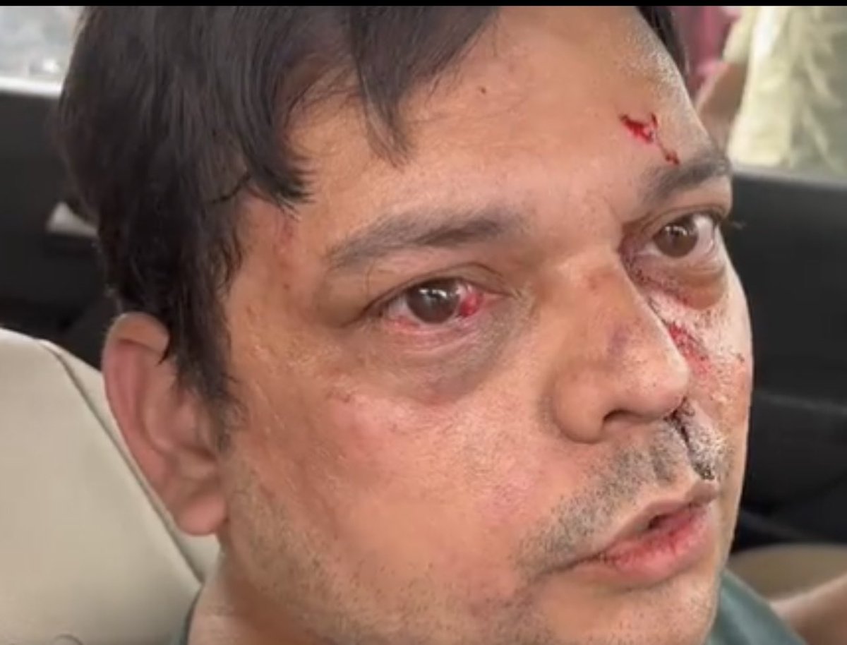 suryapsingh_IAS's tweet image. डॉक्टर पल्लव बाजपेयी का आरोप है वे अस्पताल से घर जा रहे थे, रास्ते में कवि कुमार विश्वास के सुरक्षागार्ड्स ने कार को रास्ता न देने की वजह से उन्हें बहुत पीटा, लहुलुहान कर दिया।

उधर पेशबन्दी में कुमार विश्वास ने एक ट्वीट कर उल्टे डॉक्टर पर ही हमले का आरोप जड़ दिया, जिसे…