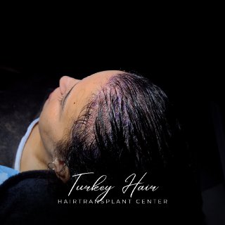 TurkeyHairCentr's tweet photo. FEMALE HAIR TRANSPLANT  

Where is the best place in the whole Europe 🌍 for hair transplant treatment? 

“Turkey hair transplant center” this answer was given to our patient Raluca on Google. And she is so happy to be part of our big family📷. . 

Turkey Hair Transplant Center © 
Europe’s Best Hair Transplantation Center  
Change starts with us!  

Follow for more information: https://t.co/M0SJqrJQRK  

Trump Trump Trump | Butter | Curry | Eren | Jokic |