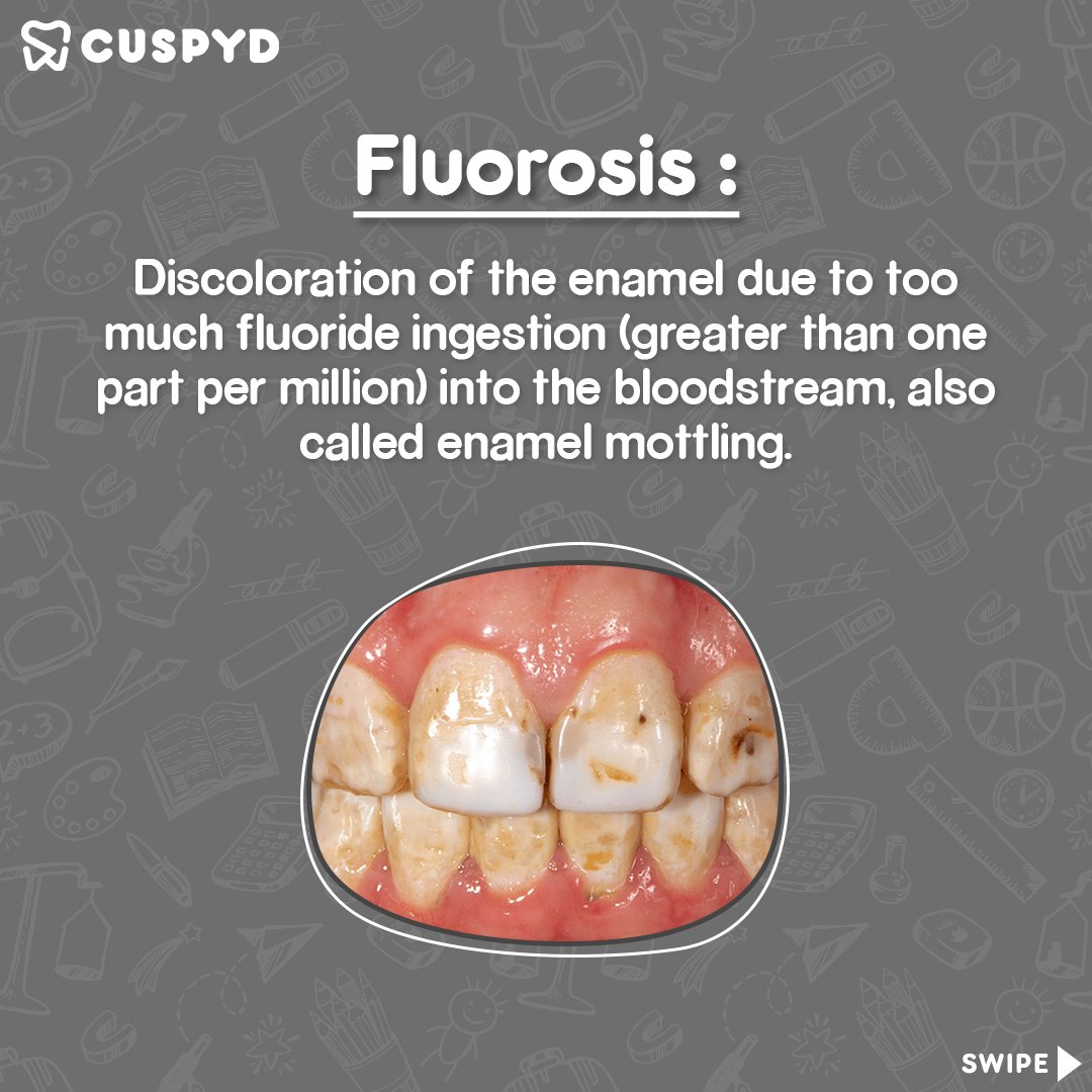 cuspyd_dental's tweet photo. "ABCs of Dentistry". 
Today starting with the letter 🌟#F
for your weekly dose of dental #terminologies &amp; their #meanings 
Follow @cuspyd_dental

 #easyunderstanding #learn #dentistry #easylearning #Dental #dentalterminology #studytwt #KnowBeforeYouGo https://t.co/iIzCtgH3oe