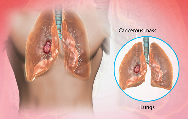 November is Lung Cancer Awareness Month! The risk factors include: - Smoking - Radiation therapy - Asbestos and other heavy metals like cadmium, selenium, etc., can also increase the risk. - Family history of lung cancer ncikenya.go.ke/blog/52