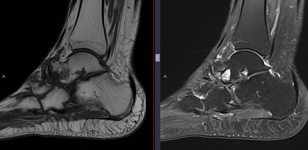 9/11/2023. Müller-Weiss syndrome: sclerosis and collapse with 'comma-shaped' deformity of the lateral aspect of the navicular bone on X-Ray + severe Chopart and subtalar OA. #foot #MRI #Xray #osteonecrosis