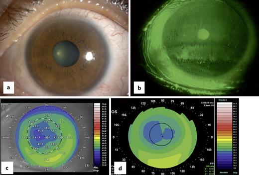 OphthaKarger's tweet photo. Blepharokeratoconjunctivitis Presumably Caused by Paederus fuscipes, a Beetle: A Case Report
โก๏ธ https://t.co/FYCND3hXIH
โ๏ธ Ono T. et al.
๐ #CaseRepOphthalmol
#OpenAccess https://t.co/ppbd2ZD5un