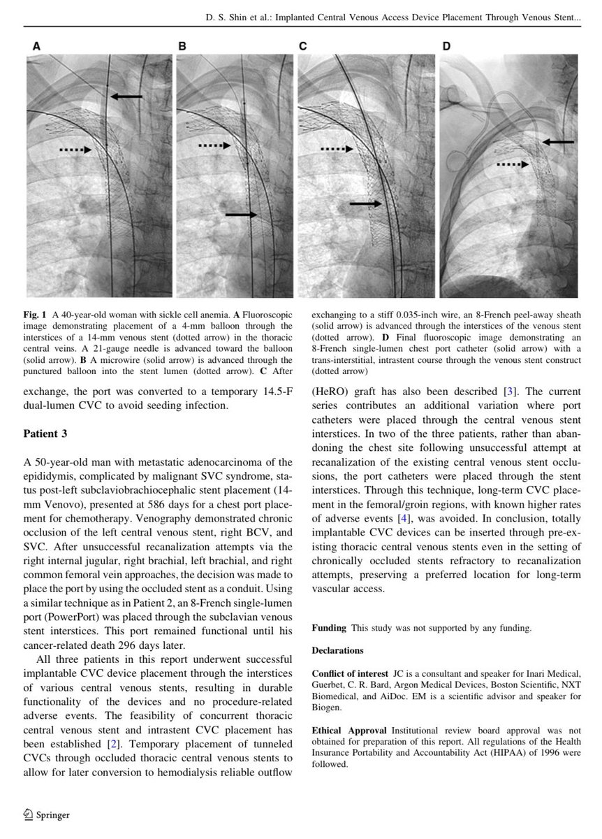 Jeffrey F. B. Chick, MD, MPH (@chickvir) on Twitter photo Totally implantable central venous access devices may be inserted through pre-existing thoracic central venous stent interstices, preserving a preferred location for long-term vascular access.
<a href="/CVIR_Journal/">CVIR Journal</a> <a href="/SIRspecialists/">Society of Interventional Radiology</a> <a href="/UWRadiology/">UW Radiology</a> <a href="/UofWa_IR/">University of Washington IR Residency</a> <a href="/Eric_Monroe_MD/">Eric Monroe, MD</a> <a href="/mabadsantos/">Matt Abad-Santos</a> Totally implantable central venous access devices may be inserted through pre-existing thoracic central venous stent interstices, preserving a preferred location for long-term vascular access.
<a href="/CVIR_Journal/">CVIR Journal</a> <a href="/SIRspecialists/">Society of Interventional Radiology</a> <a href="/UWRadiology/">UW Radiology</a> <a href="/UofWa_IR/">University of Washington IR Residency</a> <a href="/Eric_Monroe_MD/">Eric Monroe, MD</a> <a href="/mabadsantos/">Matt Abad-Santos</a>