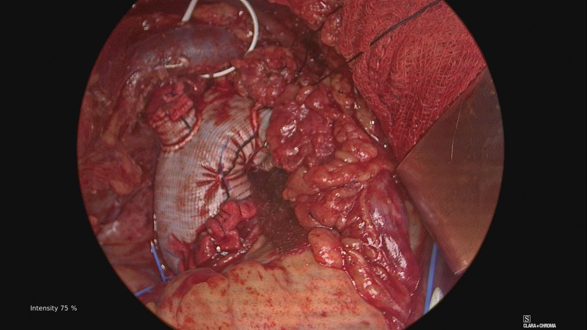 JHH Vascular Surgery (@jhhvascular) on Twitter photo Thoraflex time! Always great to collaborate with our CT colleagues <a href="/HopkinsCTSurg/">Johns Hopkins Cardiothoracic Surgery</a>!
Who routinely extends the #thoraflex distally? #aortaed #aorticdissection Thoraflex time! Always great to collaborate with our CT colleagues <a href="/HopkinsCTSurg/">Johns Hopkins Cardiothoracic Surgery</a>!
Who routinely extends the #thoraflex distally? #aortaed #aorticdissection