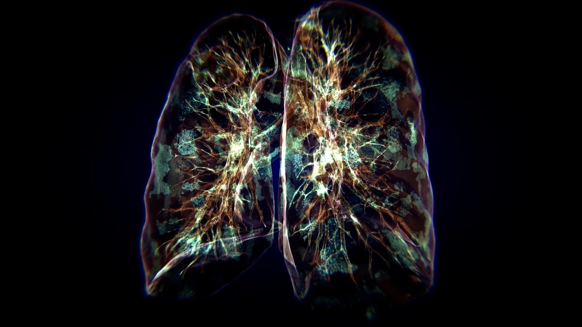 NEW: Paper published yesterday in @NatureComms, led by the Ho Group (@OxfordBRC & @CAMS_COI_Ox), provides new insights into how immune cells interact in the lungs of patients with severe COVID-19 🫁 Read more: bit.ly/3sodtsN