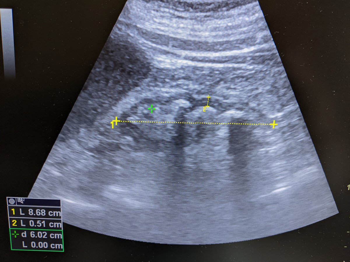 #POCUS #renal #Nephpearls 
What are we talkin about when we talk about nephrocalcinosis.
( Monolateral in this case, possible evolution of a Medullary Sponge Kidney)