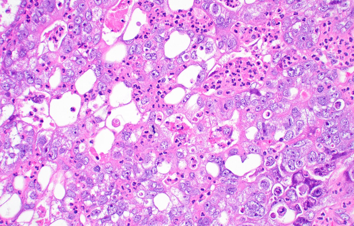 Male patient in his 70s. Large bladder tumor.
#Pathtwitter #pathology #gupath #urology <a href="/slusagar/">Ankur Sangoi</a> <a href="/Andres_Matoso/">Andres Matoso</a> <a href="/MichelleDunno17/">Michelle_Hirsch (Donovan)</a>