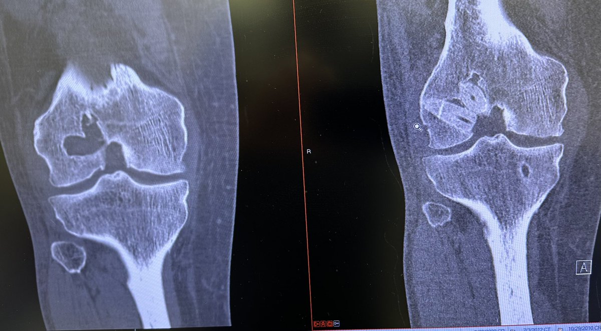 Love Bone Dowels for failed ACLR with osteolysis #orthotwitter