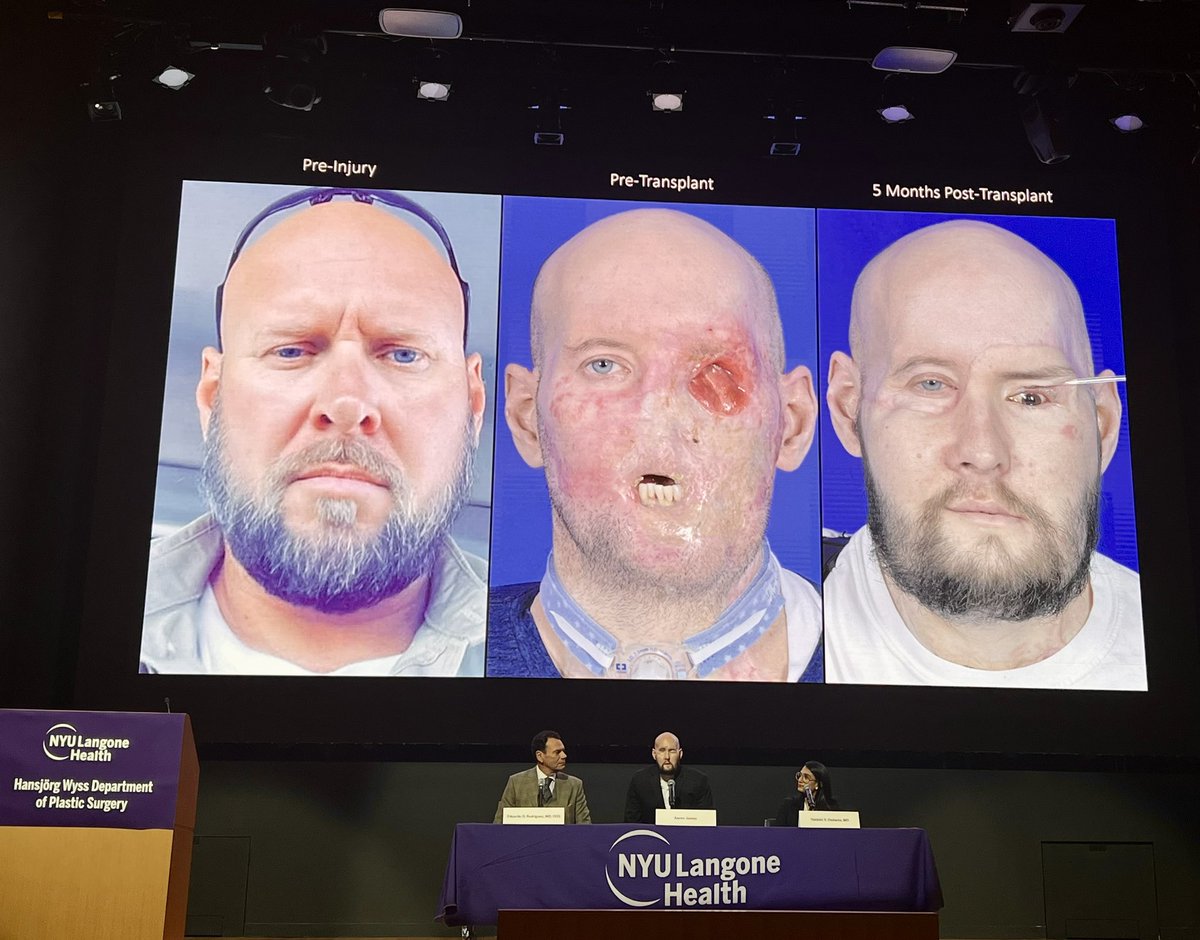 The First Successful Partial Face and Eyeball Transplant. Aaron James, war veteran and electrical injury survivor, discussing the details of the operation. Extremely inspiring work by Dr. Eduardo Rodriguez & the @nyuplastics @nyulangone Team. @beyondFACESnyc @nyugrossman