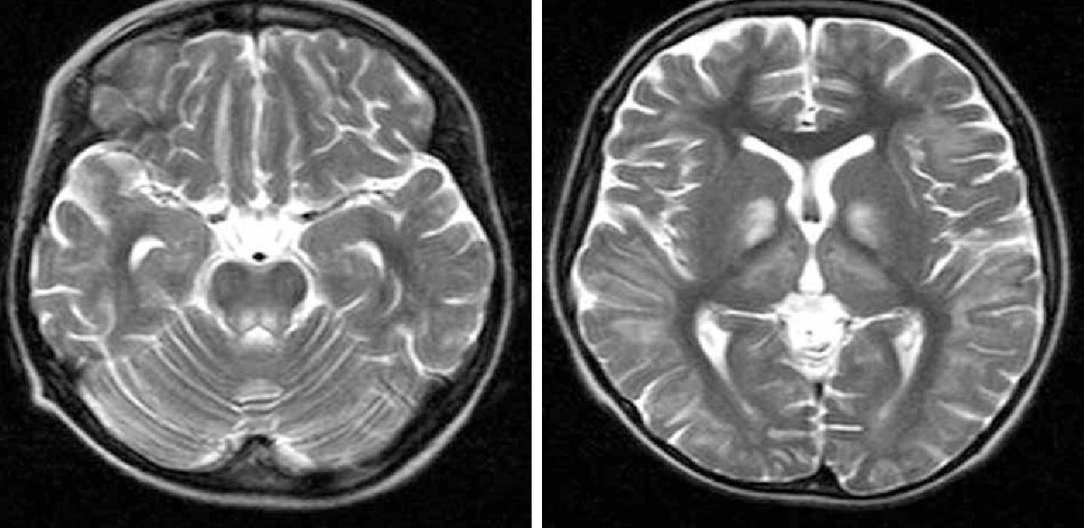 11 yo male with history of growth retardation and myopia presents with bradycardia and loss of consciousness. 

#radres #Neurology #neuroscience #neurosurgery #Radiología #raded