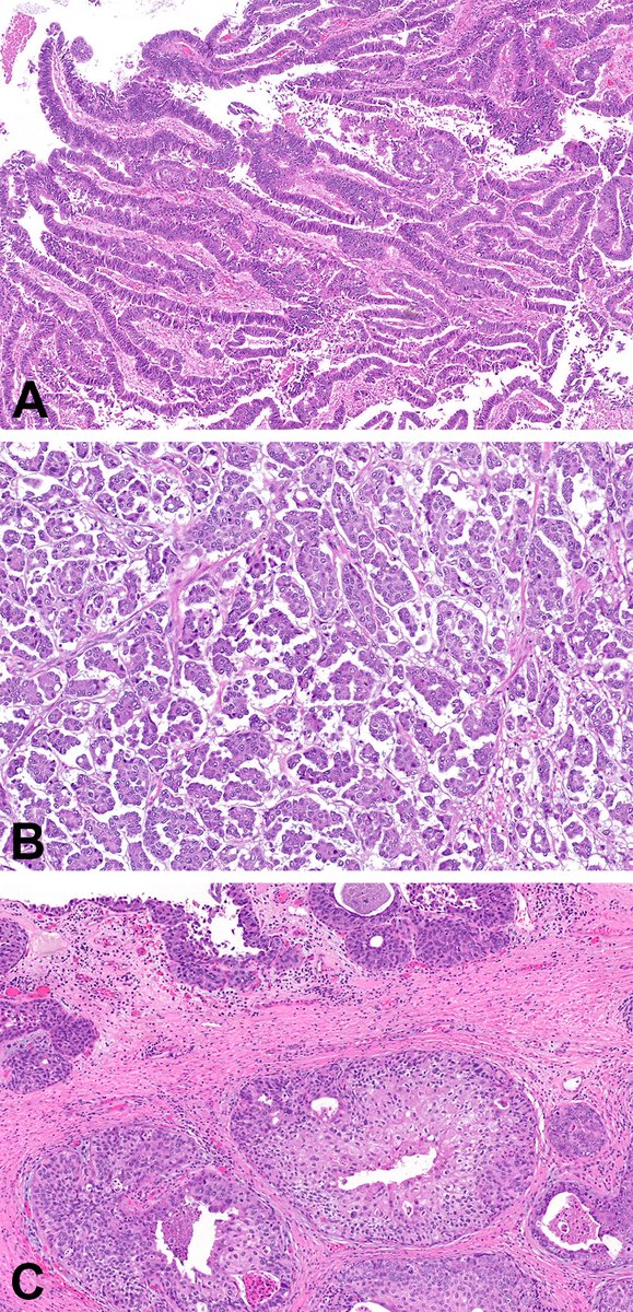 <a href="/angelorod57/">Angelo Rodrigues</a> <a href="/Andres_M_Acosta/">Andres Martin Acosta (Andy)</a> <a href="/slusagar/">Ankur Sangoi</a> <a href="/Andres_Matoso/">Andres Matoso</a> <a href="/MichelleDunno17/">Michelle_Hirsch (Donovan)</a> Similar case we published, linked here: 
journals.sagepub.com/doi/abs/10.117…